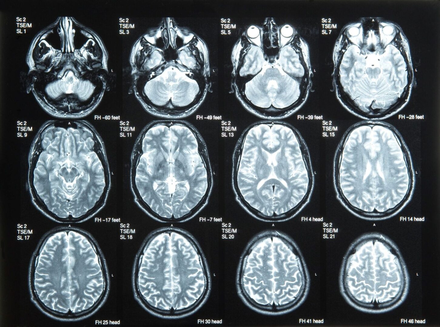 A series of mri images showing the brain.